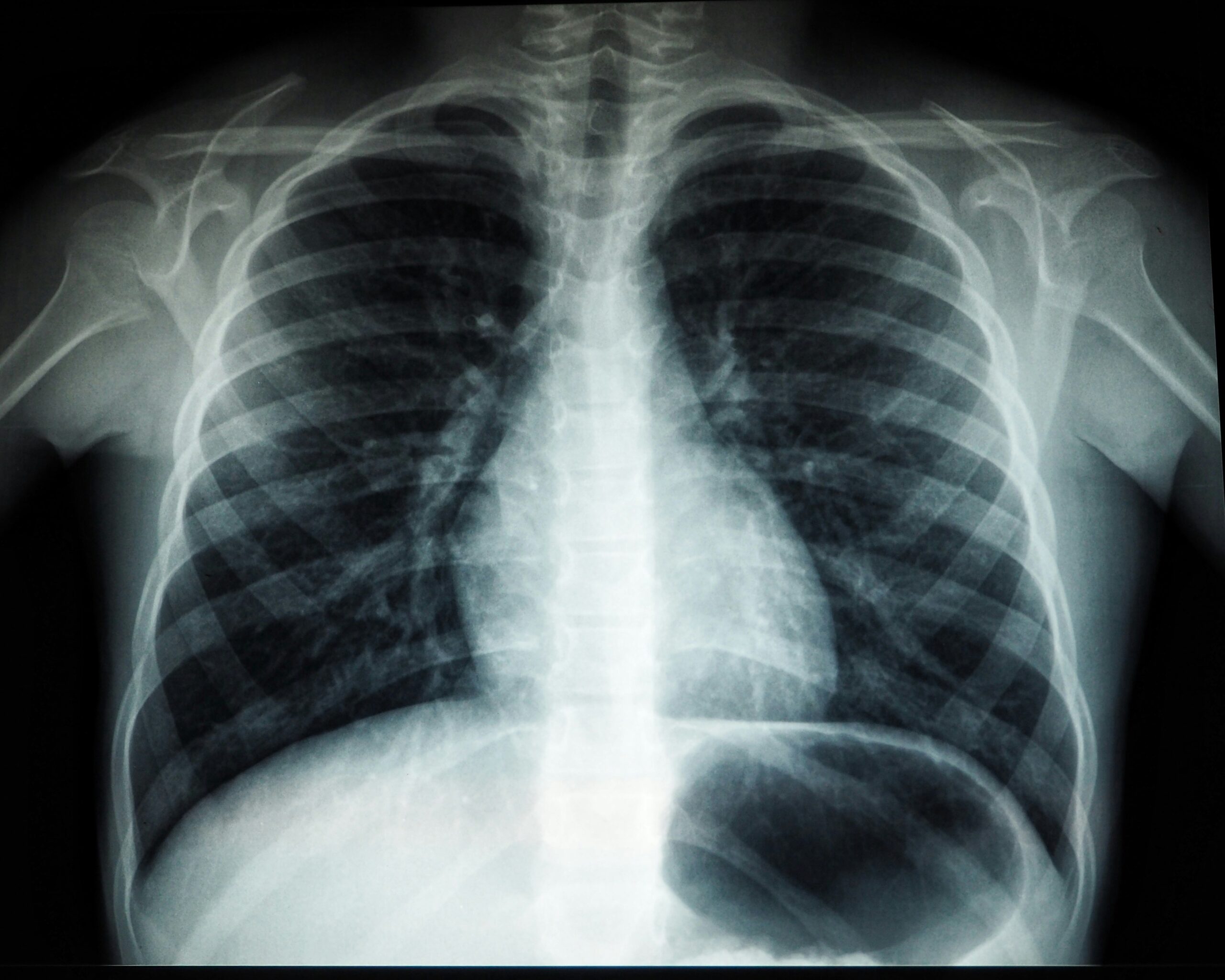 How to reduce your risk of Lung Cancer?